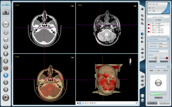 انطباق تصویر CT و MR در IV2