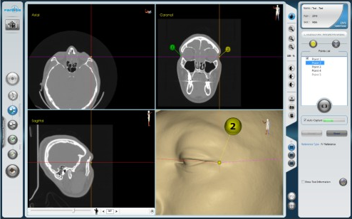 منطبق‌سازی نقاط شاخص IV2